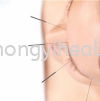  β Acupuncture Treatment 