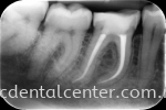 Root Canal Treatment  Root Canal Therapy