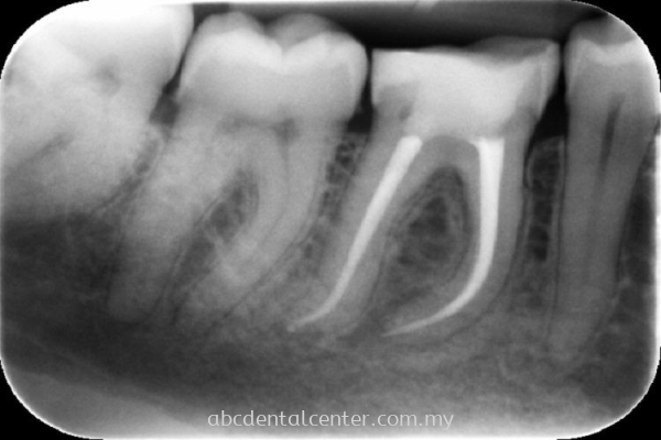 Root Canal Treatment 