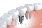 Dental Implants ֲ Dental Implants