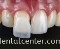 Veneer Ƭ Crown and Bridge 