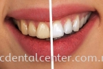 Teeth Whitening Ư Teeth Whitening