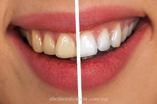 Teeth Whitening Ư