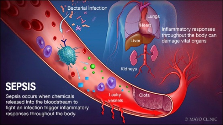 Sepsis