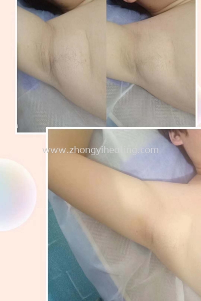  Toning Supernumerary Breasts