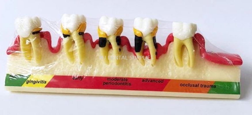 PERIODONTAL DISEASE MODEL, #M4010