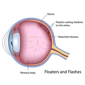 Vitreous Floaters