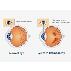 Diabetic Eye Disease