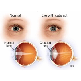 Cataract