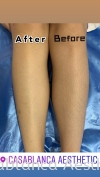 Diode Laser Hair Removal Diode Laser Hair Removal 