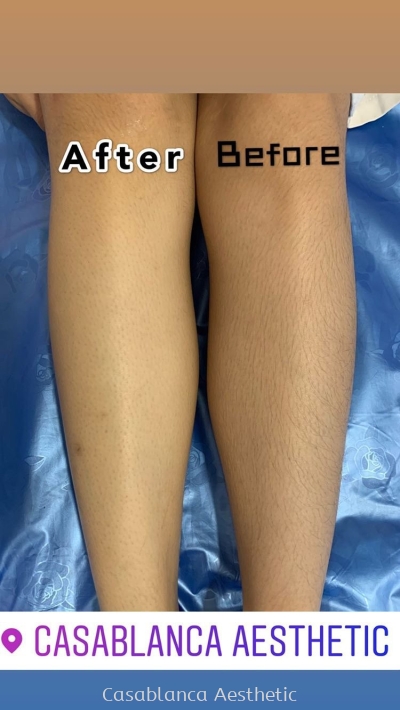 Diode Laser Hair Removal