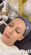 PRP Vampire Facial PRP Treatment 