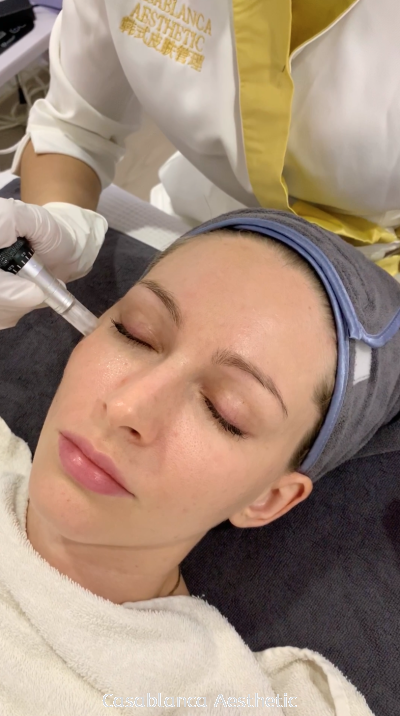 PRP Vampire Facial