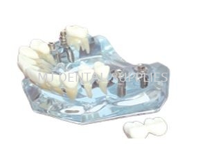 IMPLANT MODEL WITH BRIDGE, (UPPER JAW), #M2010 A