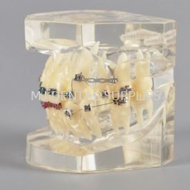 ORTHODONTIC MODEL WITH METAL BRACKET, #M3005-III