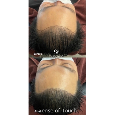 Sense Of Touch Hair Loss Treatment Testimony / 面对脱发问题 & 生发护理
