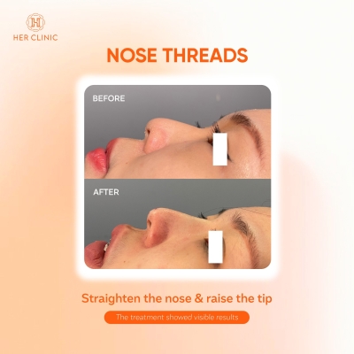 Nose Thread