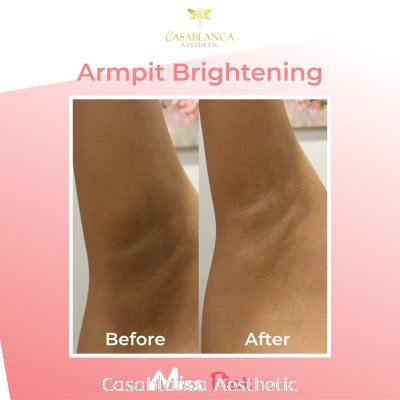 Armpit Whitening