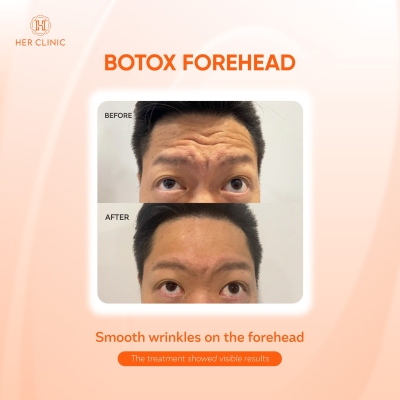 Botox Forehead