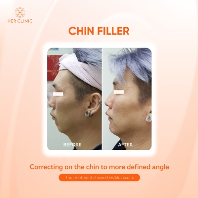 Chin Filler 