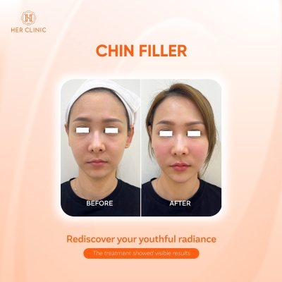 Chin Filler