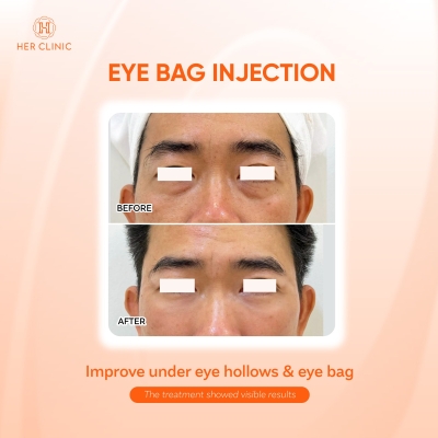 Eye Bag Injection 