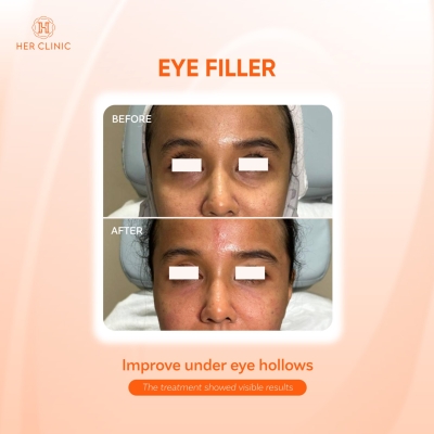 Eye Filler