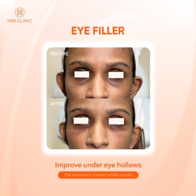 Eye Filler