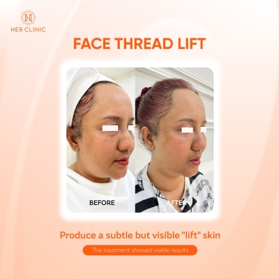 Thread lift