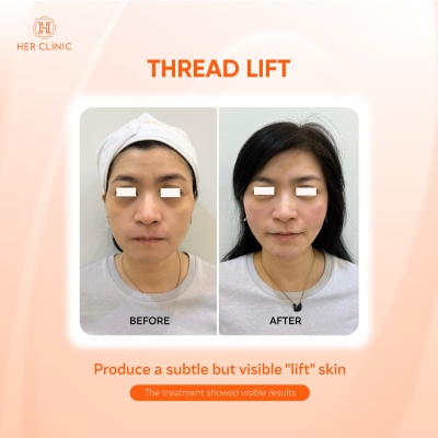 ThreadLift