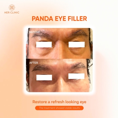 Eye Filler 