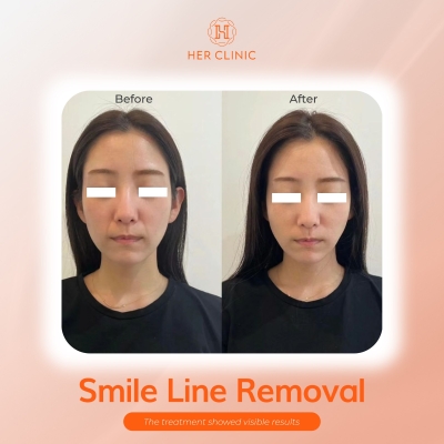 Smile Line Removal