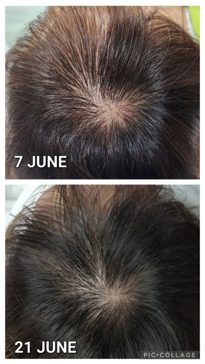 Peptide hair restorative treatment 