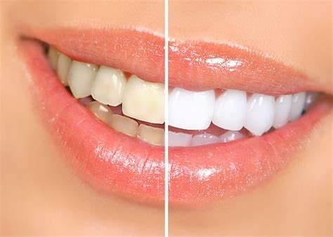 teeth whitening package