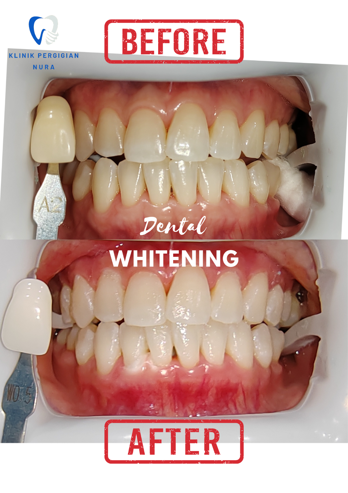 WHITENING