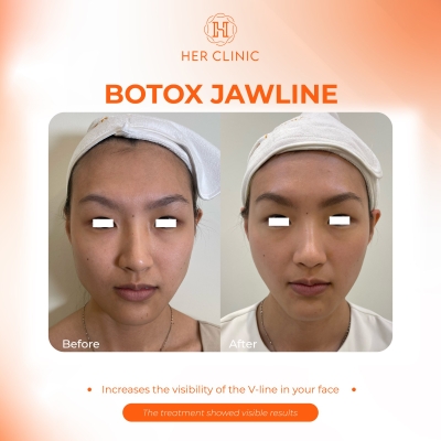 Botox Jawline