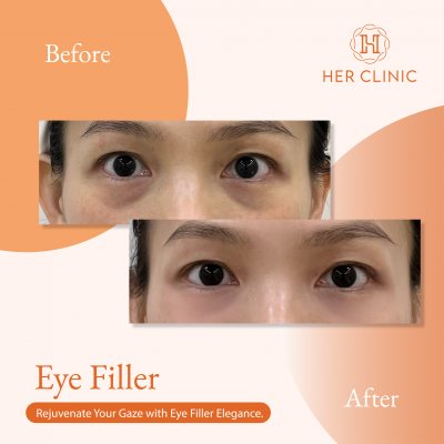 Eye Filler