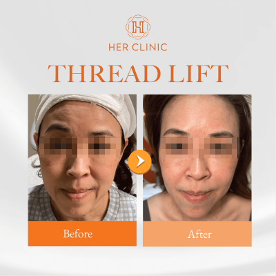 Face Threadlift