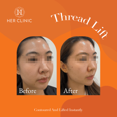 Face Threadlift