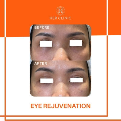 Eye Rejuvenation