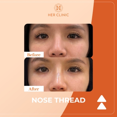 Nose Thread