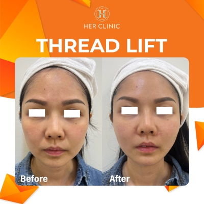 Threadlift