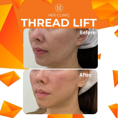 Threadlift