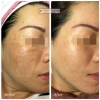 MEDEX Pico Laser Facial Treatment Services