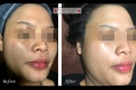 MEDEX Pico Laser Facial Treatment Services