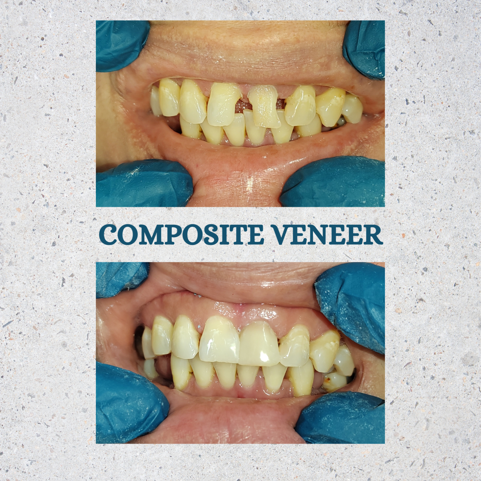 COMPOSITE VENEER