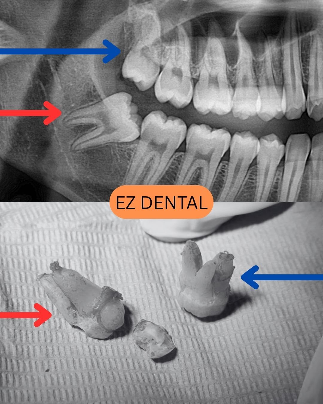 Wisdom Tooth Surgery