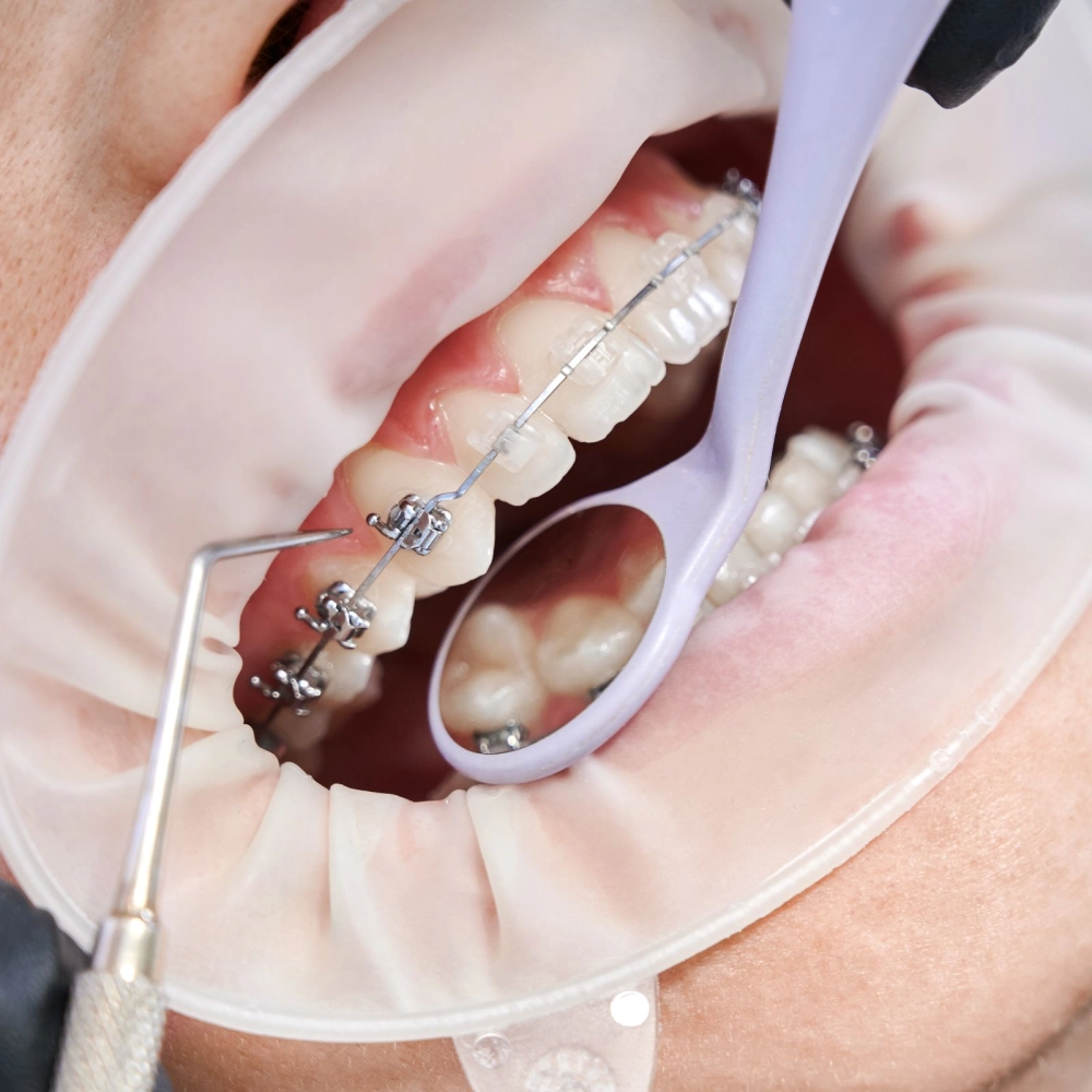 ORTHODONTIC TREATMENT