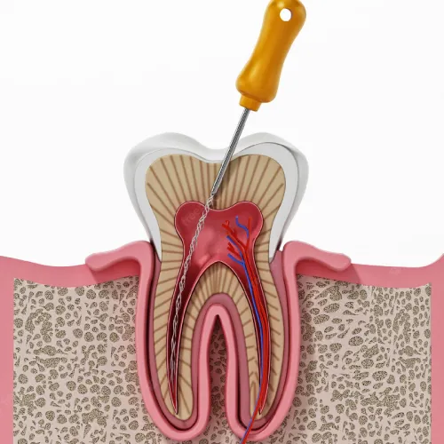 Root Canal Treatment (RCT)