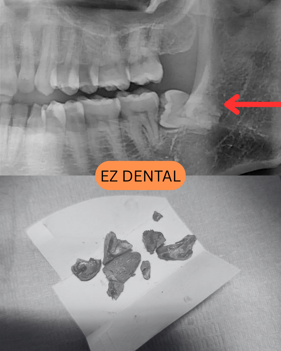 Wisdom Tooth Surgery Taman Equine